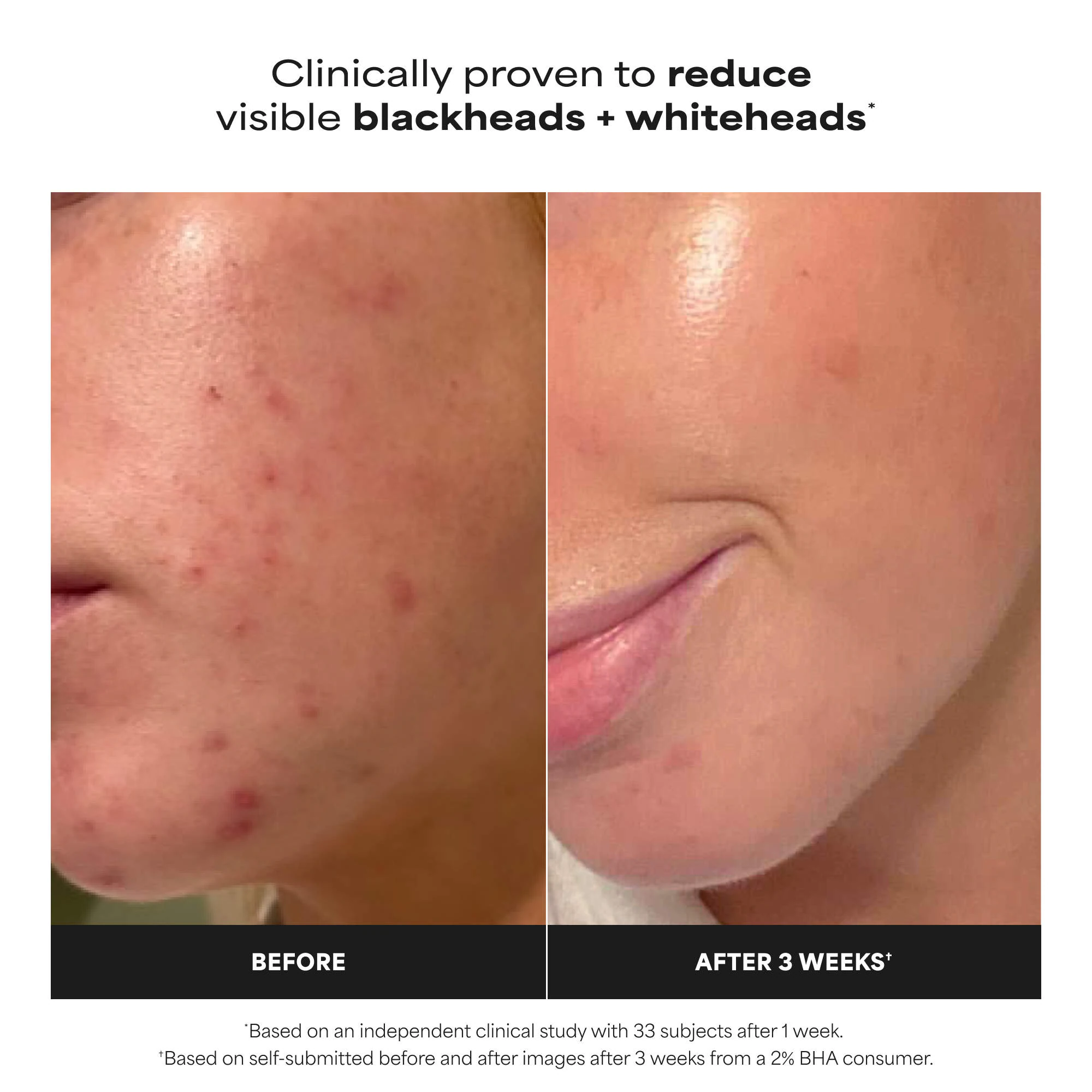 Skin Perfecting 2% BHA Exfoliating Toner for Clear Skin (30ml) — image 2